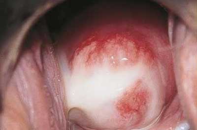عفونت واژن چه نشانه هایی دارد، درمان عفونت واژن در طب سنتی 